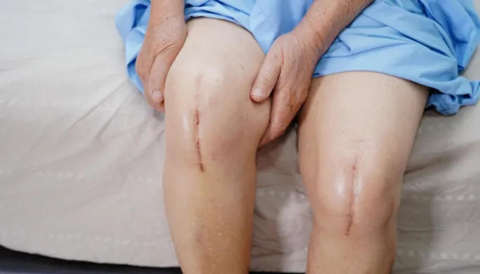 Knee Replacement Surgery
